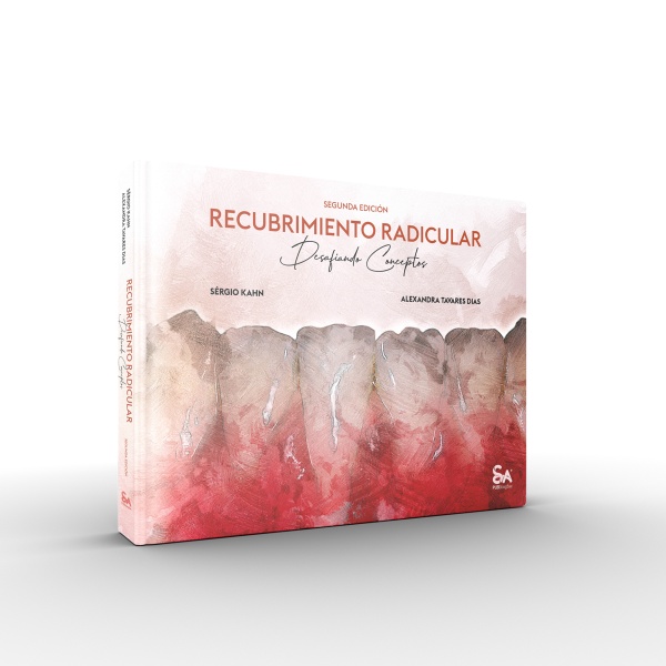 Recubrimiento Radicular – Desafiando Conceptos